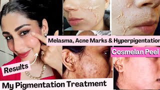 COSMELAN PEEL Best Skin Peel for Hyperpigmentation Acne marks Melasma treatment at home Dr Menka [upl. by Ynnatirb]