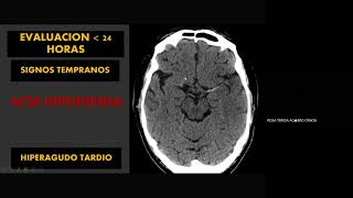 Evaluación Radiológica del Accidente Cerebro Vascular [upl. by Nanfa]