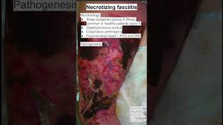 Necrotizing fasciitis [upl. by Sayres]