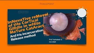 Innovative Removal of the Cortical Girdle in a White Mature Cataract and Iris Incarceration release [upl. by Jilly573]