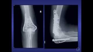 3 plates for Distal Humerus Fractures [upl. by Applegate]