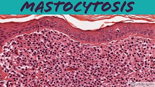 Mastocytosis 5Minute Pathology Pearls [upl. by Ottavia]