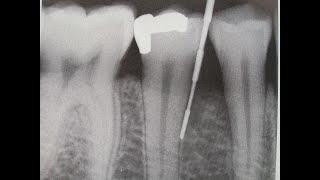 PERIODONTITIS y radiografía [upl. by Gerger]