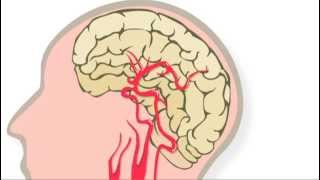 Trombolyse behandeling na een herseninfarct [upl. by Selima]