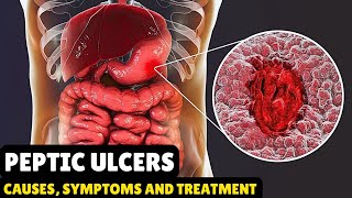 Peptic Ulcers – Causes Signs and Symptoms Diagnosis amp Treatment [upl. by Hirasuna]