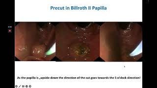 ERCP amp Sphincterotomy in Billroth II Anatomy [upl. by Annayehc664]