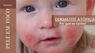 Dermatite Atópica  O que é dermatologia dermatiteatopica vlog cuidadoscomapele youtuber [upl. by Petit]