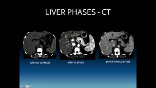 Characterization of Liver Masses with Contrast Enhanced US What Sonographers Need to Know Ultrasoun [upl. by Adnarrim359]