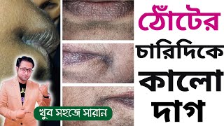 ঠোঁটের কোনে কালো দাগ সারানোর উপায়  Dr Supratim Saha [upl. by Barbaraanne782]