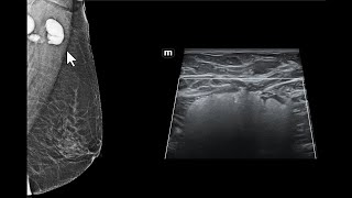 Impregnação de linfonodos axilares por silicone Achados da mamografia e da ultrassonografia [upl. by Balling]