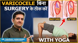 Yoga for Varicocele Relieve Pain and Promote Circulation  Dr Gaurav Gangwani [upl. by Grory163]