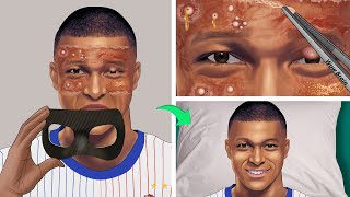 Treatment of ulcers on Kylian Mbappés face caused by wearing a training mask for too long [upl. by Nosremaj]