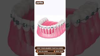 Correct Your Bite and Straighten Your Teeth with Braces [upl. by Narual]