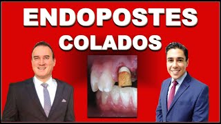 ENDOPOSTES METÁLICOS VACIADOS O COLADOS POSTES DE ENDODONCIA [upl. by Naivaj653]