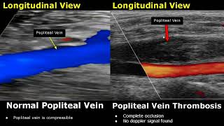 Popliteal Vein Doppler Ultrasound Normal Vs Abnormal Image Appearances  Deep Vein Thrombosis USG [upl. by Tabor683]