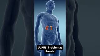 LUPUS Problemas Renais doencaautoimune doencasautoimune lupus [upl. by Innus]