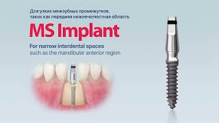 MS Implant [upl. by Valera]