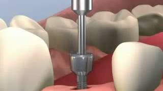 Simulación 3d colocacion de implantes [upl. by Lion272]