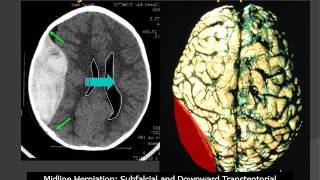 MedPix® Traumatic Brain Injury  Epidural Hematoma RadiologicPathologic Correlation [upl. by Ahsael530]