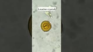 Leucine crystals in urine under microscopeurinalysismicroscopyurology [upl. by Drofdarb]