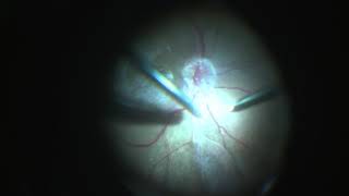 Posterior Vitreous Detachment PVD induction safe technique [upl. by Mulac523]