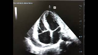 Septal bounce Constrictive Pericarditis [upl. by Ellemaj]