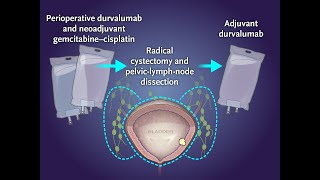 Perioperative Durvalumab in Bladder Cancer  NEJM [upl. by Ataymik]