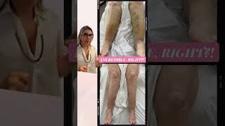 How To Treat Lipedema With Massage Treatments After LipoSuction [upl. by Llewol]