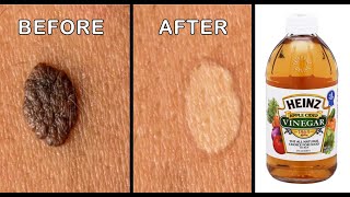 Mole Removal By Apple Cider Vinegar  Effective Ways to Remove Skin Tags Naturally [upl. by Nageem]