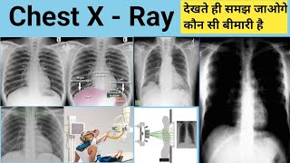 Chest X Ray  X Ray  X Ray Reading  Pneumonia  Lungs Effusion  X Ray Technician  Doctor  bhms [upl. by Innor]