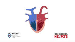 Ventricular Septal Defect [upl. by Bohi]