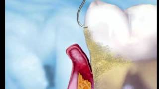 Periodontal Treatment India  Gum Flap Surgery in Dental Clinic Bangalore [upl. by Togram465]