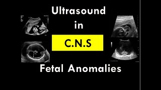 Ultrasound in CNS foetal anomalies [upl. by Clift]