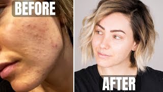 SKINCARE ROUTINE  acne prone skin [upl. by Nikki]