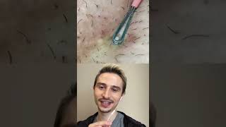 How not to use a comedone extractor dermreacts skincare pimplepopping shorts [upl. by Strenta]