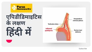 Epididymitis Symptoms Causes and Treatment  Epididymitis Homeopathy Medicine  Paras Homeopathy [upl. by Toomay]