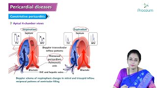 Pericardial Disease Hindi  Etiology Clinical Features Diagnosis Treatment and Complications [upl. by Karwan]