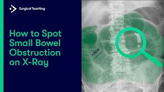 Small Bowel Obstruction  How do we Diagnose it on Abdominal XRay [upl. by Gilges105]