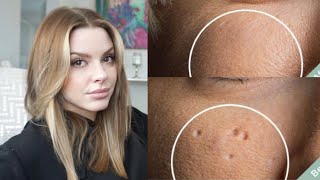 Esthetician Discusses How To Eliminate Pitted Acne Scars [upl. by Ive801]