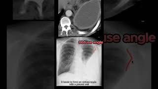 Empyema vs Pleural Effusion vs Lung Abscess radiology radiologystudent medicalstudent [upl. by Cordelie]