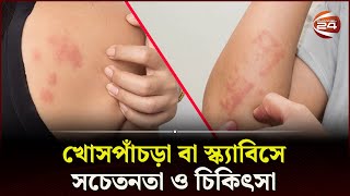 খোসপাঁচড়া বা স্ক্যাবিসে সচেতনতা ও চিকিৎসা  Scabies  Health Tips  Skin Care  Channel 24 [upl. by Dnyletak26]