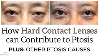 How Hard Contact Lenses can Contribute to Eyelid Ptosis and Other Causes [upl. by Ahtoelc458]