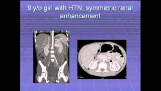 SIRRFS Webinar 3713 Diagnosis and Management of Renovascular Hypertension in Children [upl. by Sualkin]