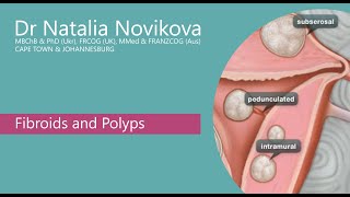 Fibroids and Polyps [upl. by Laddie150]