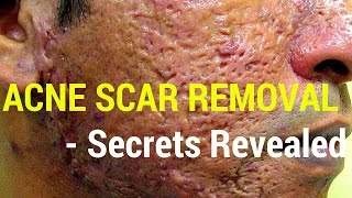 How to treat acne scars Dermatology Secrets revealed [upl. by Barfuss752]