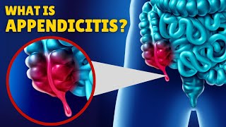 Appendicitis – Causes Signs and Symptoms Diagnosis amp Treatment [upl. by Cochard]