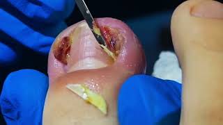 Remove a DEEP Ingrown Nail from Ugly Rotten Toenail [upl. by Matthia]