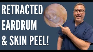 EAR WAX REMOVAL RETRACTED EARDRUM AND SKIN REMOVAL  EP455 [upl. by Sully]