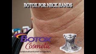 Botox Cosmetic in the Platysmal Bands AKA Neck Bands [upl. by Landri38]