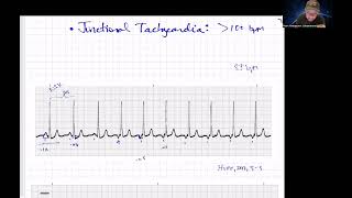 Quick Junctional Rhythms Review Paramedic Cardiology [upl. by Ahserak]